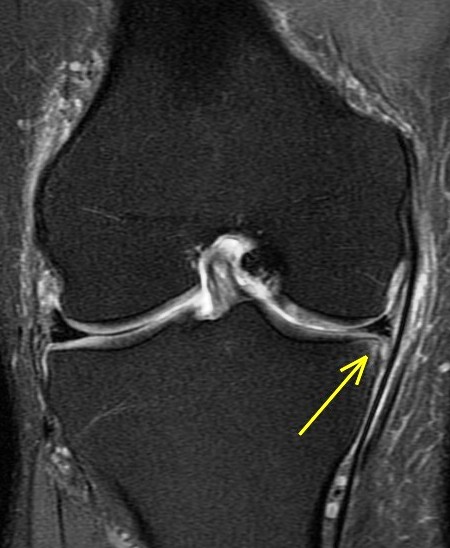 Figure 4 for case Unstable displaced medial meniscus tear( RID2772 ) with reactive tibial edema